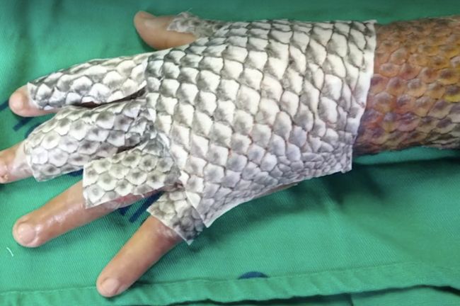 Doctors Use Unusual Treatment For Her Severe Burns