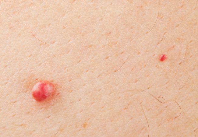 get-rid-of-skin-tags-with-this-easy-and-natural-solution