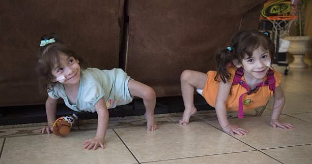 Formerly Conjoined Twins Are Thriving At Home After Risky Surgery To Separate Them