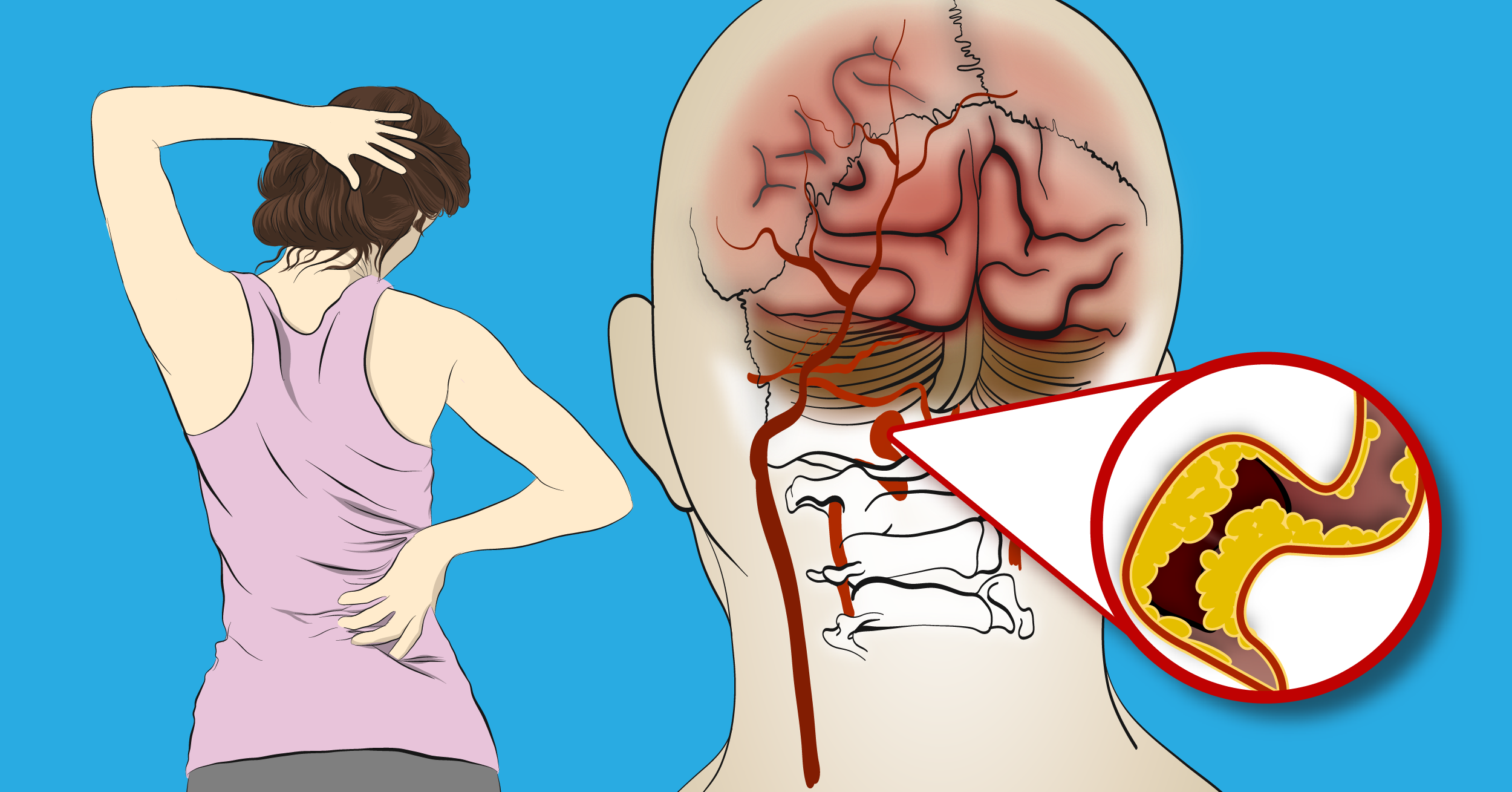 All Women Need To Know Symptoms Of A Stroke And How To Prevent Them