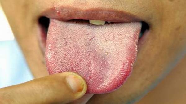 What Does A White Bump On Tongue Mean