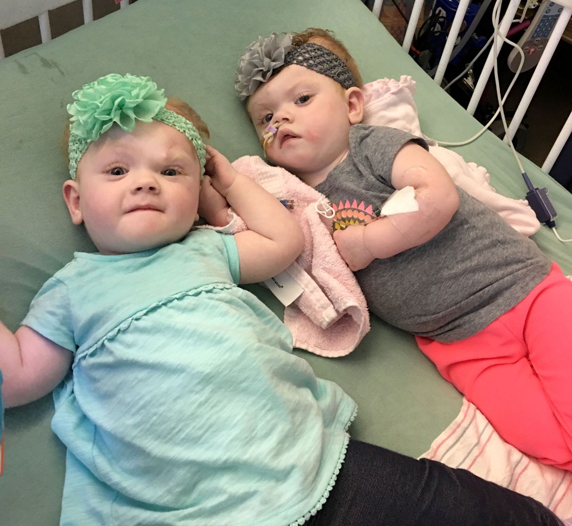 5 Months After Life Changing Surgery, Former Conjoined Twins Are