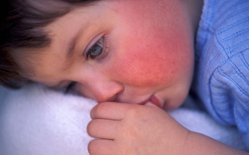 scarlet-fever-is-back-and-you-need-to-know-the-signs