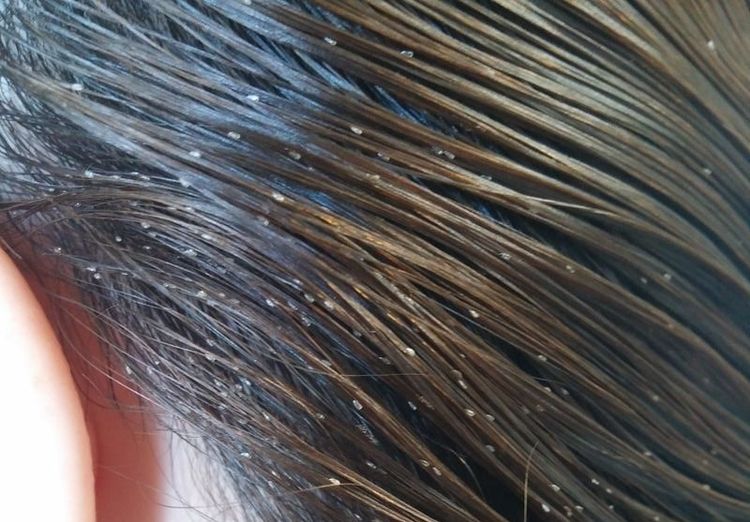 There's A Rise In Head Lice Cases Because Of A Common Christmas Tradition