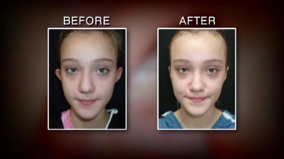 11 Year Old Gets Bullied Into Plastic Surgery