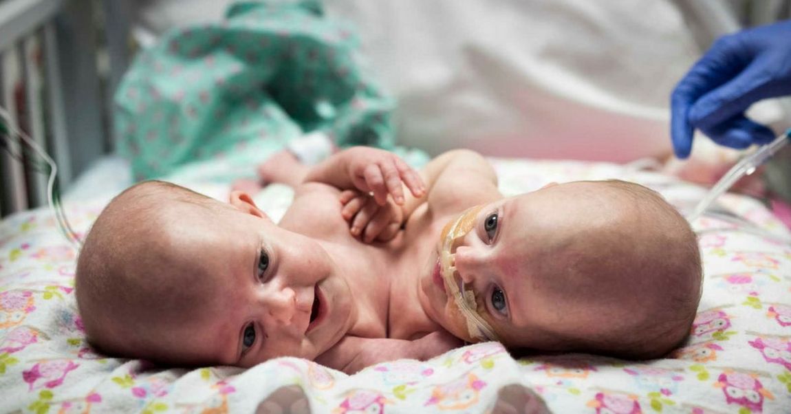 Conjoined Twin Girls Separated At Texas Children's Hospital