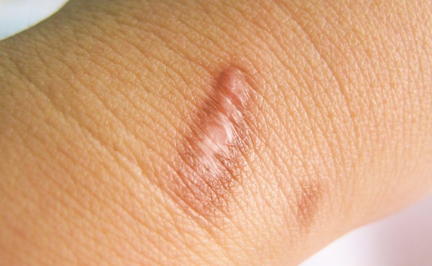 This 4 Ingredient Homemade Treatment Will Get Rid Of Your Scars And 