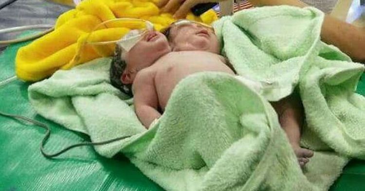 Conjoined Twins Born With One Body And Two Heads Fight For Their Life