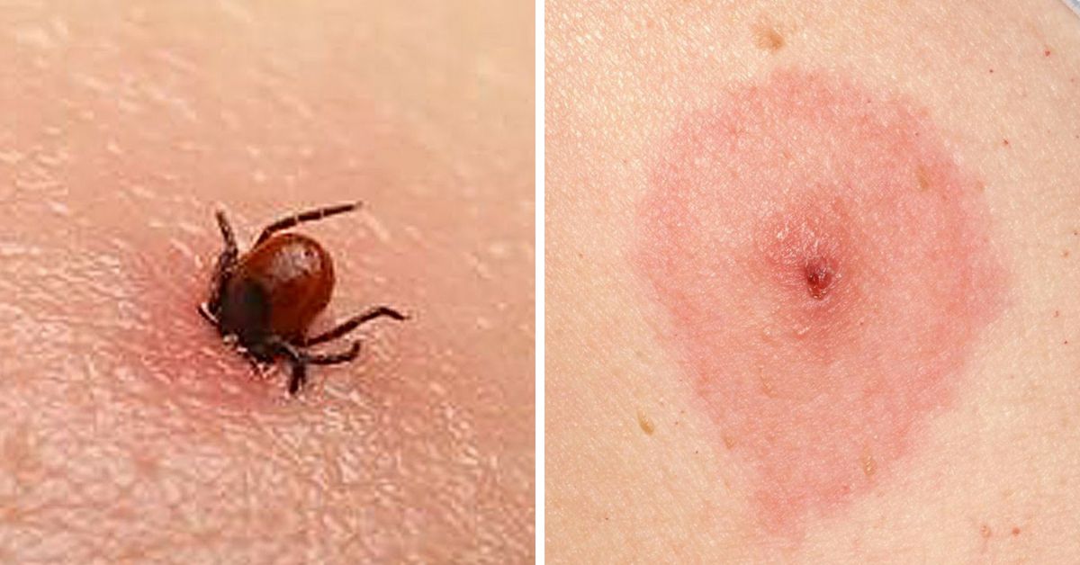 12 Common Bug Bites And How To Recognize Each One