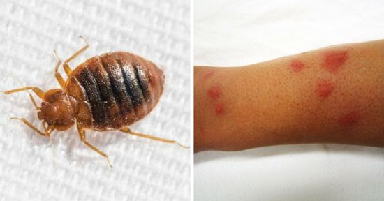 12 Common Bug Bites And How To Recognize Each One