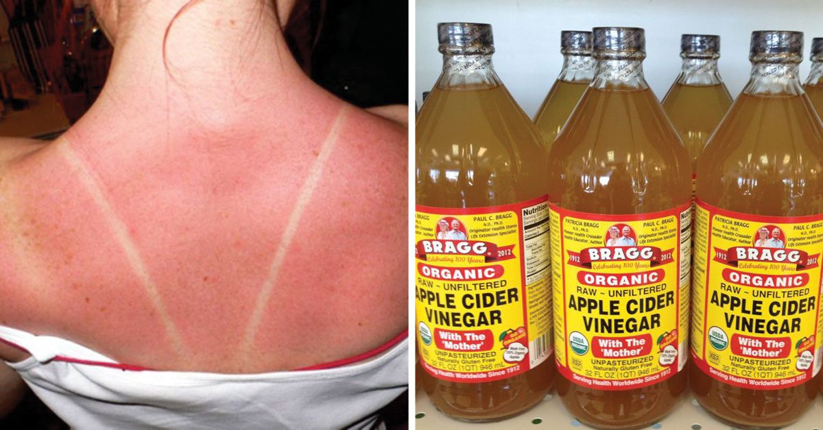 apple cider vinegar sunscreen