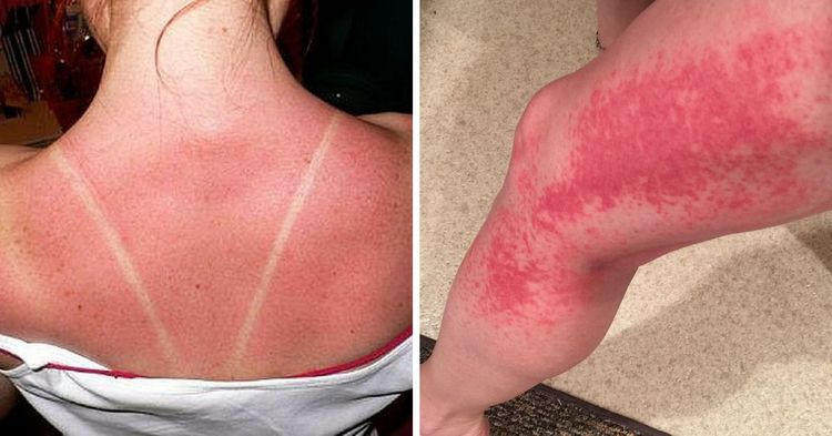 5-signs-your-sunburn-is-actually-sun-poisoning