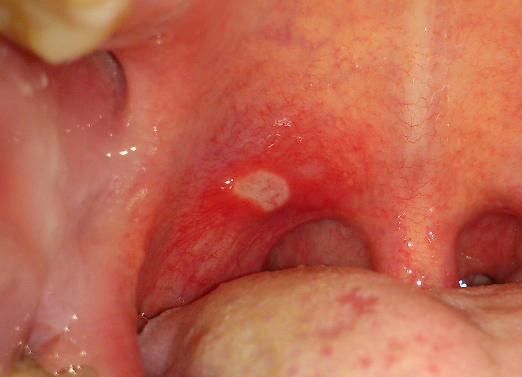 What Is Actually Causing Those Annoying Canker Sores 