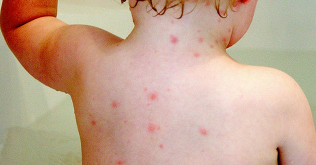 11-month-old-suffers-stroke-after-contracting-chicken-pox-from