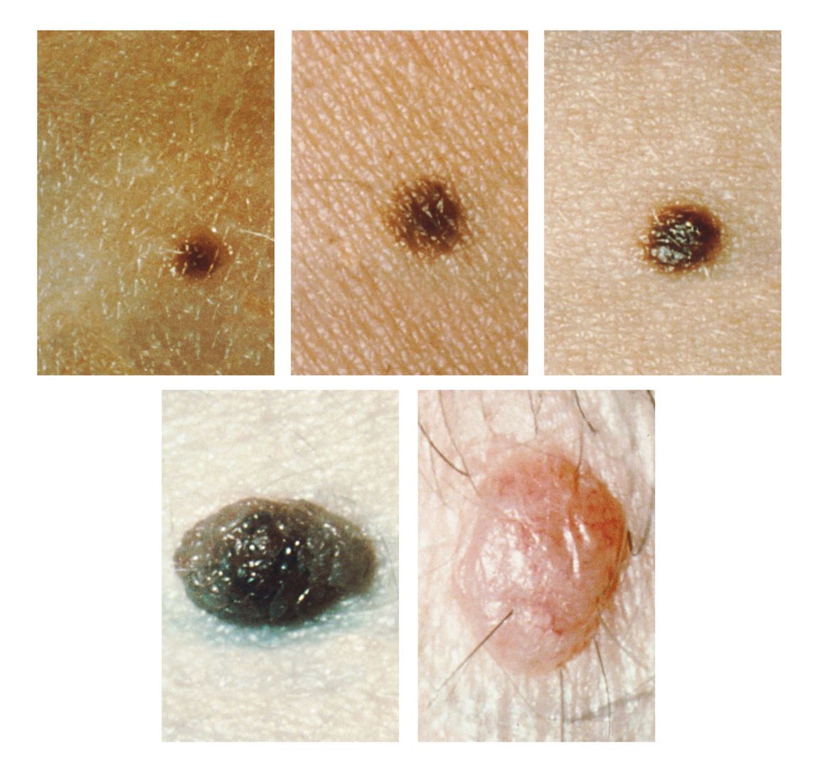 How To Know When Your Moles Are Becoming Cause For Concern