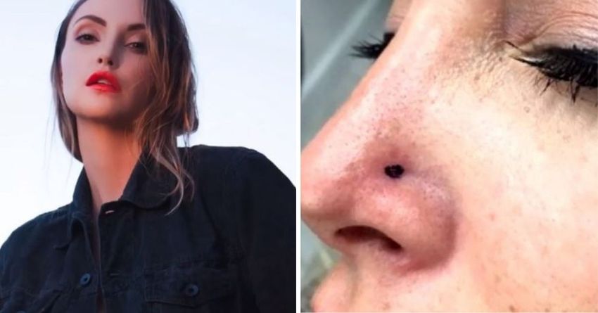 Woman Sends Out Warning After Learning Her Pimple Was Actually Skin Cancer