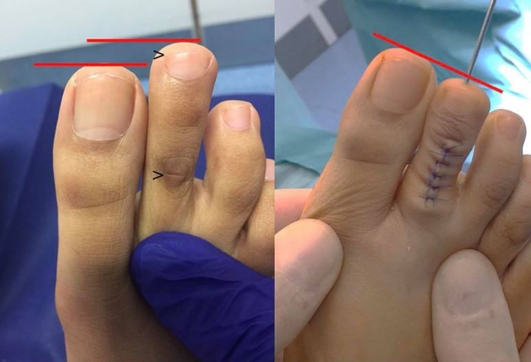 Thousands Of People Are Getting Cinderella Surgery On Their Toes 