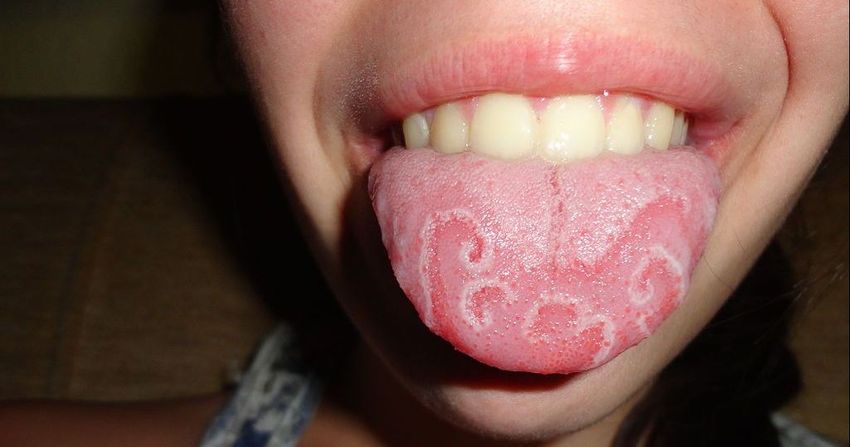9 Things Your Tongue Is Trying To Tell You About Your Health
