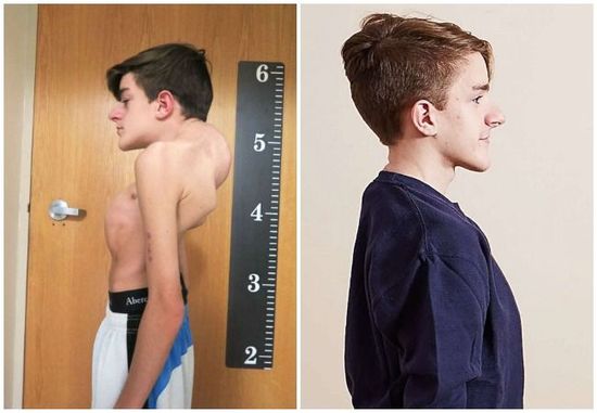 Teenager With Severe Scoliosis Is Transformed After Surgery