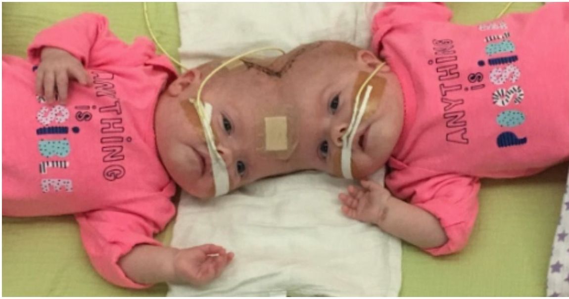 A Year After Their Separation Conjoined Twins Celebrate Their New Lives 5708