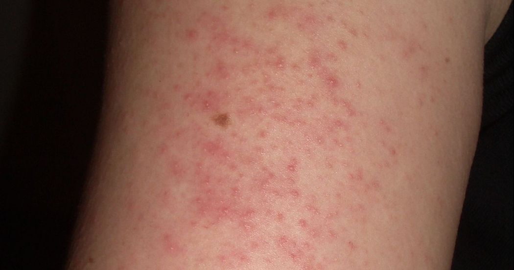 Small Red Spots On Upper Arms