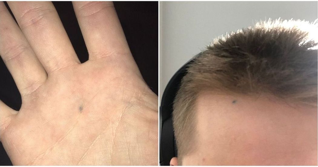 Still Have Lead Pencil Marks In Your Skin? It's Surprisingly Common